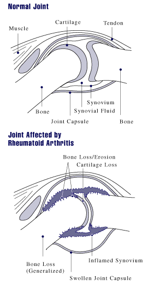 Diagram Of Arthritis